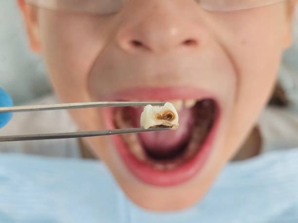 Best Emergency Treatment for Oral Infections in Cowpens, SC